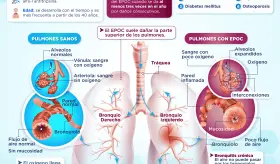 Enfermedad Pulmonar Obstructiva Crónica | Infografía