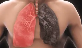 Diferencias y relación entre bronquitis crónica, Enfermedad Pulmonar Obstructiva Crónica y enfisema