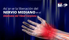 Así se ve la liberación del nervio mediano en el Síndrome del Túnel Carpiano -  #MSPCiencia