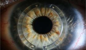 Solución al queratocono mediante el implante de anillos intracorneales o intraestromales: ¿Cómo funciona?