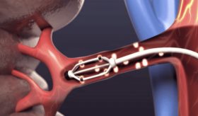 Denervación renal para reducir tensión producida por riñones y combatir hipertensión resistente