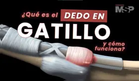 ¿Qué es el dedo en gatillo o trigger finger y cómo funciona? - #ExclusivoMSP