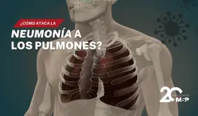 ¿Cómo ataca la neumonía a los pulmones? - #ExclusivoMSP