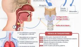 Traqueostomía | Infografía