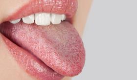 Baja protección contra bacterias, candidiasis oral y otras consecuencias de la sequedad bucal