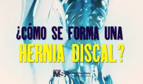 ¿Cómo se forma una hernia discal?