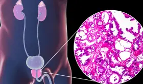 ¿Dificultad o goteo al miccionar? Podría estar padeciendo Hiperplasia benigna de la próstata