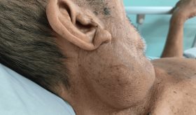 ¿Qué son los tumores benignos como pólipos y cómo diferenciarlos de los tumores malignos?