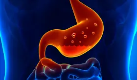 Qué es la gastritis y por qué la producción excesiva de ácido estomacal provoca úlceras gastroduodenales