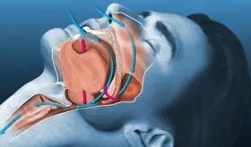 Estudio revela que el sudor nocturno es clave para determinar la gravedad de la apnea del sueño