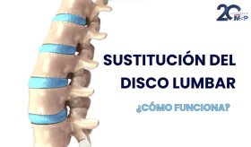 ¿Cómo y para qué se realiza una sustitución del disco lumbar? - #ExclusivoMSP