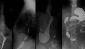Protrusión de órganos, obesidad, uso de cinturones ajustados y otras causas de hernia hiatal