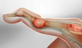 ¿Qué es el dedo en martillo? Todo lo que debe saber sobre esta lesión traumática e incapacitante