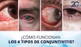 ¿Qué es la conjuntivitis y cuáles son sus cuatro tipos? - #ExclusivoMSP