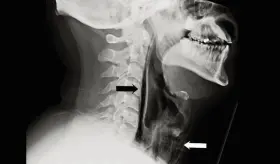 Médicos advierten el peligro de evitar estornudar después de que hombre sufriera ruptura en la tráquea