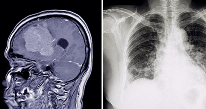 Mal de altura: signos y complicaciones como edema cerebral o pulmonar debido a entornos de gran altitud