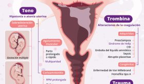 Hemorragia postparto | Infografía