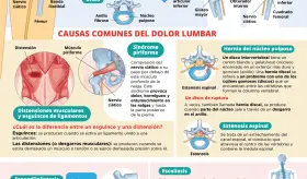 Dolor lumbar | Infografía