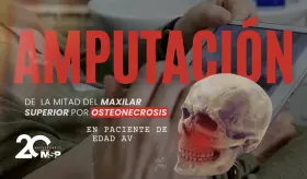 Amputación de la mitad del maxilar superior por osteonecrosis en paciente de edad avanzada - #MSP
