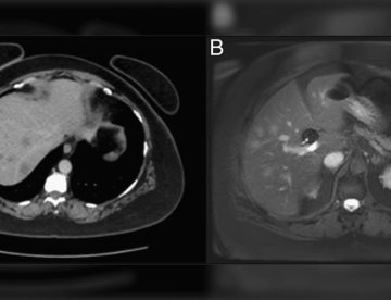 Artritis reumatoide seronegativa desencadena raro caso de nódulos hepáticos en paciente femenina