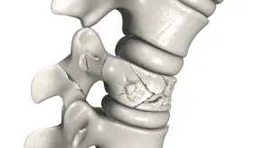 Cómo reconocer las fracturas por estrés debido a tensión repetitiva en una región ósea específica