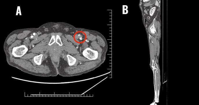 Isquemia aguda unilateral de extremidades simula ICTUS en paciente con palidez y ausencia de pulso