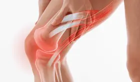 ¿Por qué el tamaño del menisco influye en el dolor de rodilla de algunas personas?