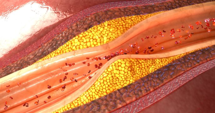 Preocupa aumento de hipertrigliceridemia en jóvenes y su conexión con el alto riesgo de diabetes tipo 2