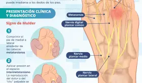 Neuroma de Morton | Infografía