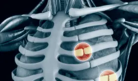 ¿Dolor punzante en el pecho que empeora con la respiración? Costocondritis es la inflamación responsable