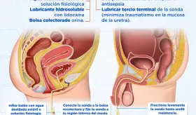 Sondaje vesical | Infografía