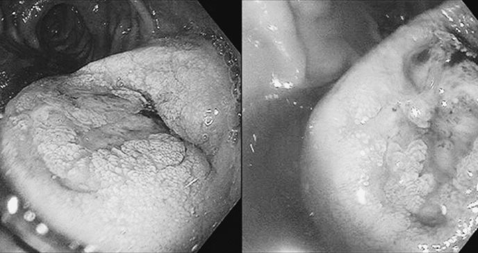 Detectan embolia por cristales de colesterol en riñón y leiomioma duodenal en paciente con hipertensión