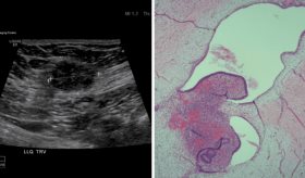 Detectan endometriosis cutánea en cicatriz de cesárea: ¿Qué es la endometriosis cicatricial?
