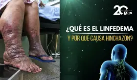 ¿Qué es el linfedema y por qué causa hinchazón? - #ExclusivoMSP