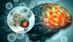 Fármacos para diabetes, colesterol y triglicéridos reducirían riesgo de cáncer cerebral en diábeticos