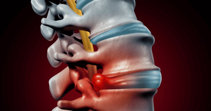 Diabetes tipo 2 altera anatomía estructural de discos en la columna vertebral y reduce su funcionalidad