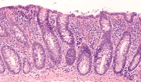 Colitis microscópica: la enfermedad intestinal difícil de detectar que más afecta a mujeres