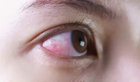 ¿Por qué duelen los ojos luego del eclipse solar? Reconozca los signos de daño ocular o retinopatía solar