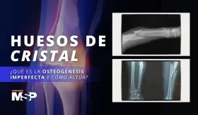 Huesos de cristal: ¿Qué es la osteogénesis imperfecta y cómo actúa? - #ExclusivoMSP