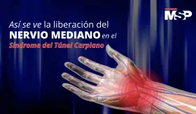Cirugía #ENVIVO: Así se ve la liberación del nervio mediano en el síndrome del túnel carpiano - #MSP