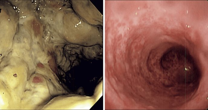 Enema de café ocasiona proctocolitis grave y necrosis de tejido intestinal