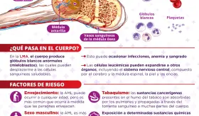 Leucemia mieloide aguda | Infografía