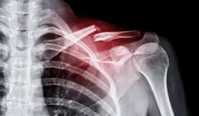 Nueva técnica de irradiación con plasma podría revolucionar la curación de fracturas óseas complejas