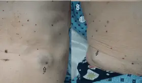 N&oacute;dulos en la piel conllevan a detecci&oacute;n de c&aacute;ncer de pulm&oacute;n en paciente con tabaquismo