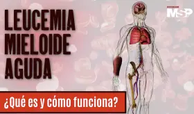Leucemia Mieloide Aguda: ¿Qué es y cómo funciona? - #ExclusivoMSP