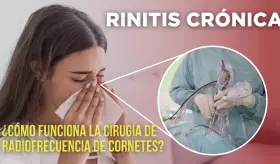 ¿Cómo funciona la cirugía de radiofrecuencia de cornetes para rinitis?