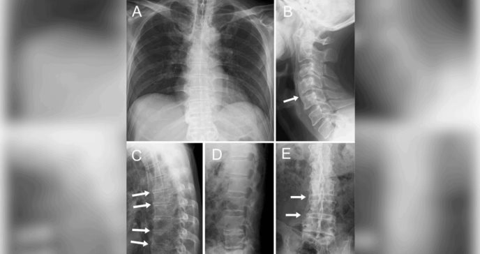 Espondilitis anquilosante se presenta con rara entesitis en localización infrecuente y fiebre