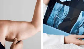 La grasa en los brazos podría ser una señal de alerta a posibles fracturas en adultos mayores