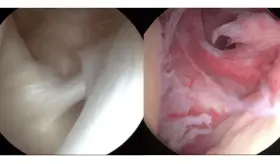 ¿Inmovilidad y dolor sordo en el hombro? Podría ser capsulitis adhesiva u hombro congelado