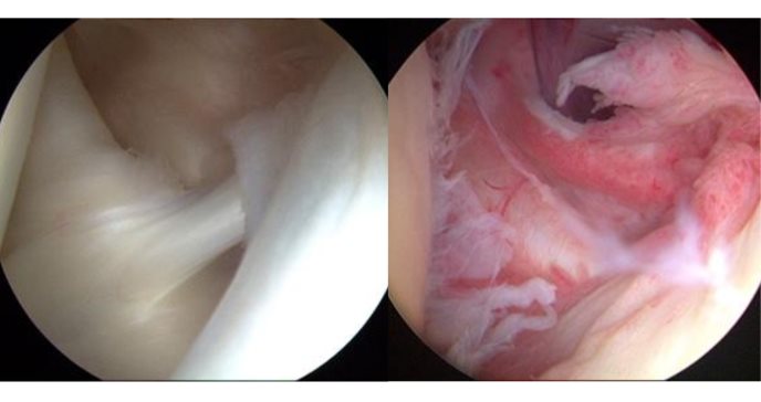 ¿Inmovilidad y dolor sordo en el hombro? Podría ser capsulitis adhesiva u hombro congelado